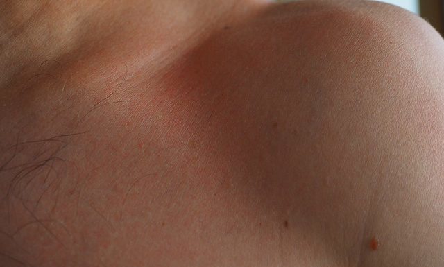 Czerniak – groźny nowotwór skóry. Jak rozpoznać czerniaka?