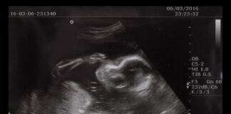 Rak, który najczęściej występuje w dziedzinie ginekologii